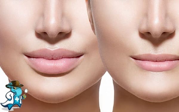 Aumento de Labios Clínica DaVinci Albacete