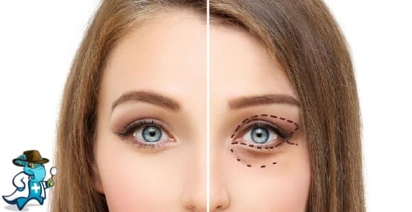 Blefaroplastia Clínica DaVinci Albacete